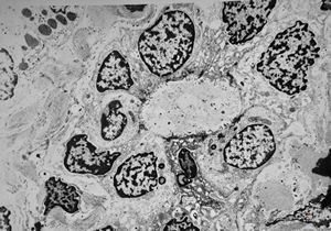 M,17y. | liver cirrhosis M,17y. | liver cirrhosis